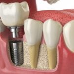 Root Canal in High Point, North Carolina