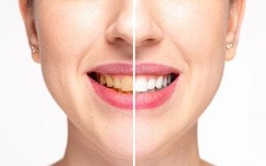 3 Advantages to Professional Teeth Whitening
