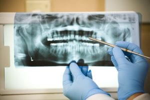 The reason most people need a root canal