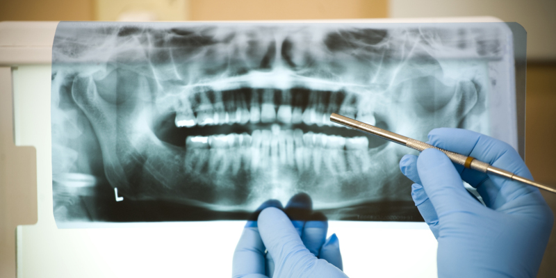 The reason most people need a root canal