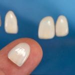 Veneers in Winston-Salem, North Carolina