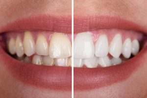3 Reasons You Should Try Teeth Whitening