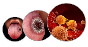 Why You Should Have Oral Cancer Screening Done