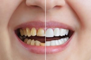 3 Options for Cosmetic Dentistry