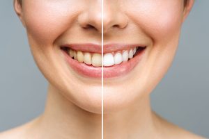 Top Benefits of Teeth Whitening