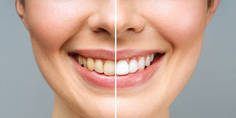 Top Benefits of Teeth Whitening