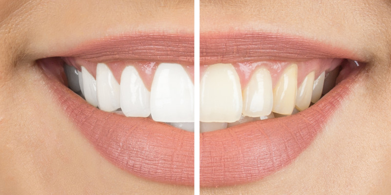 Cosmetic Dentistry in Clemmons, North Carolina