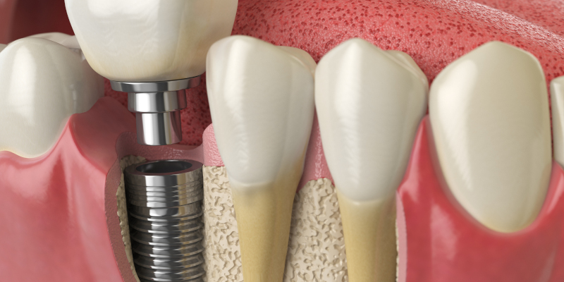 Dental Implants in Clemmons, North Carolina