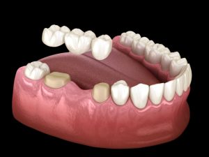 Crowns & Bridges: What’s the Difference, and Which Is Right for You?