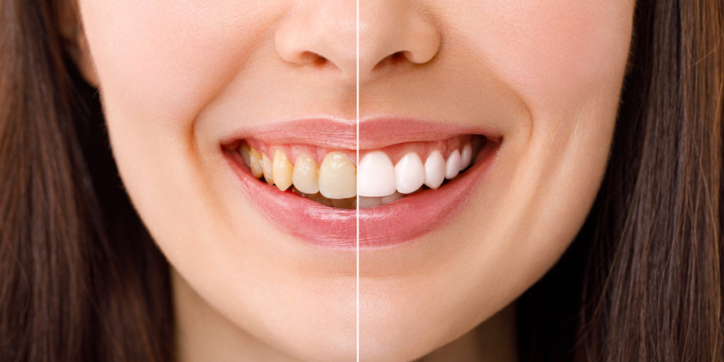 3 Cosmetic Dentistry Options to Improve Your Smile